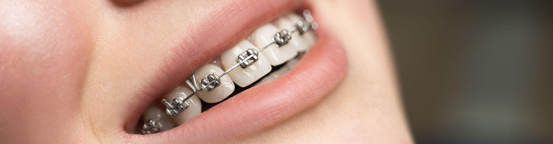 Woman's smile with braces.